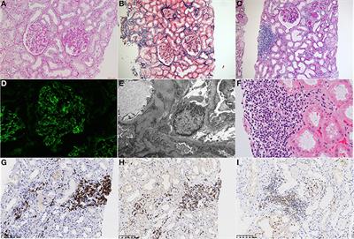 Case Report: A Rare Case of Lupus Nephritis Associated With Mantle Cell Lymphoma